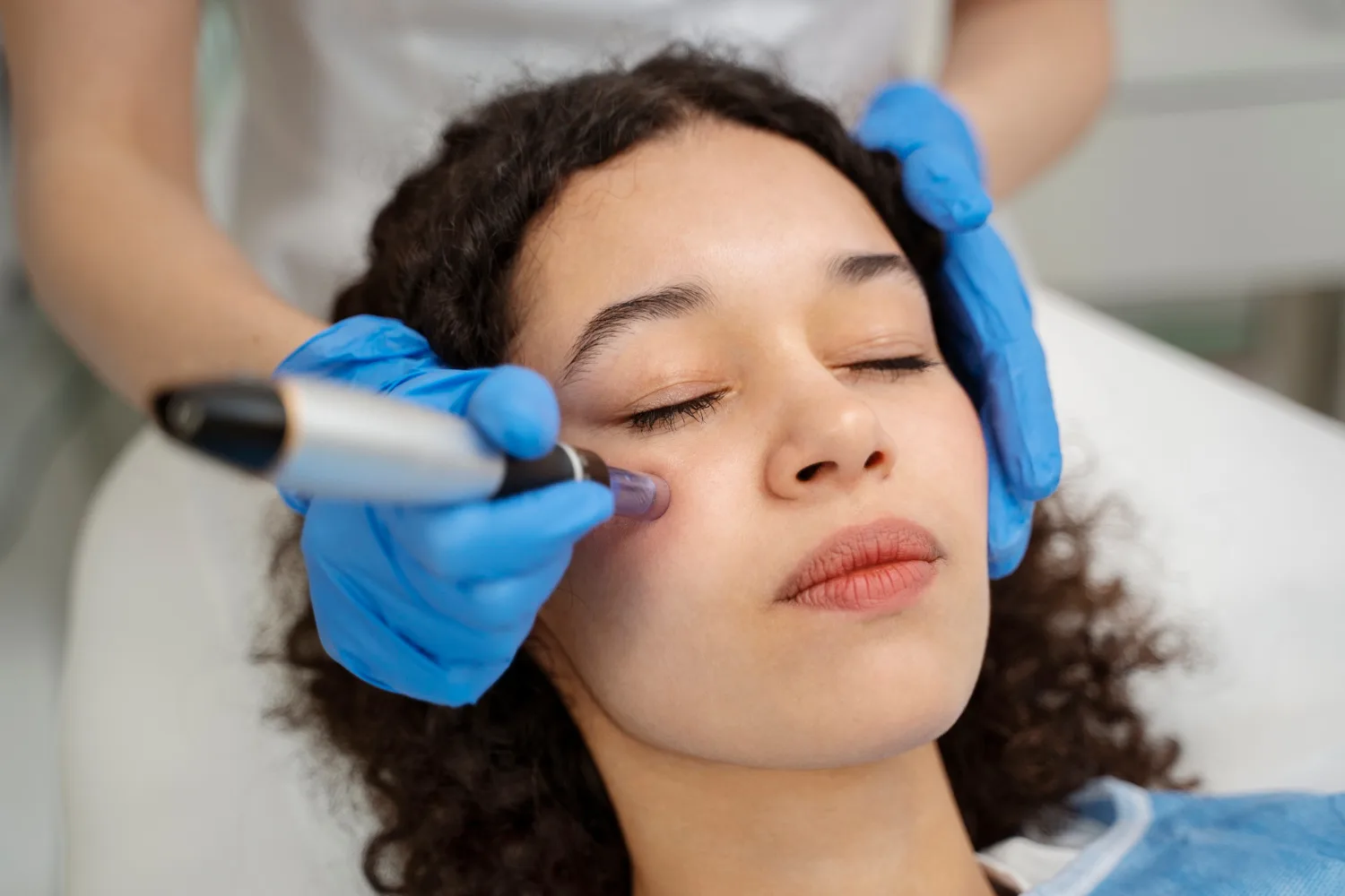 Microneedling